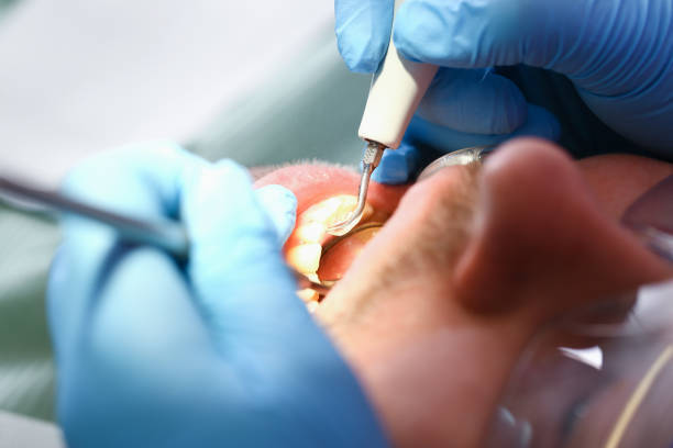 Best Emergency Tooth Extraction  in Burley, WA